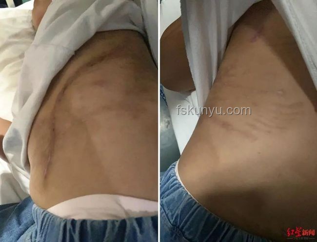 女生河边散步遇蝮蛇咬伤应急处理指南